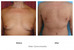 Male Gynecomastia