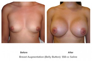 breastaug1