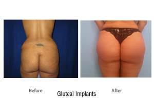 gluteal