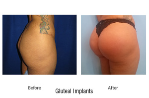 gluteal2