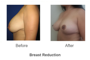 breast23