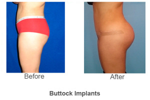buttock11