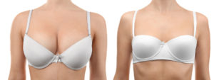 Breast reduction before after photos